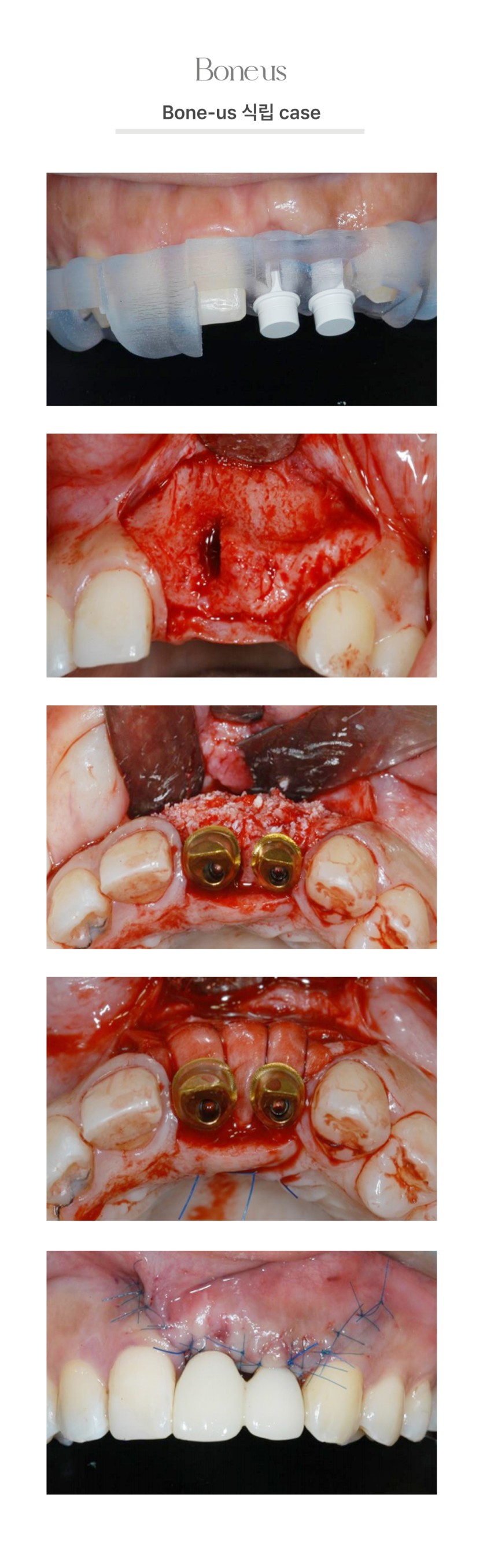본어스 식립 케이스 10