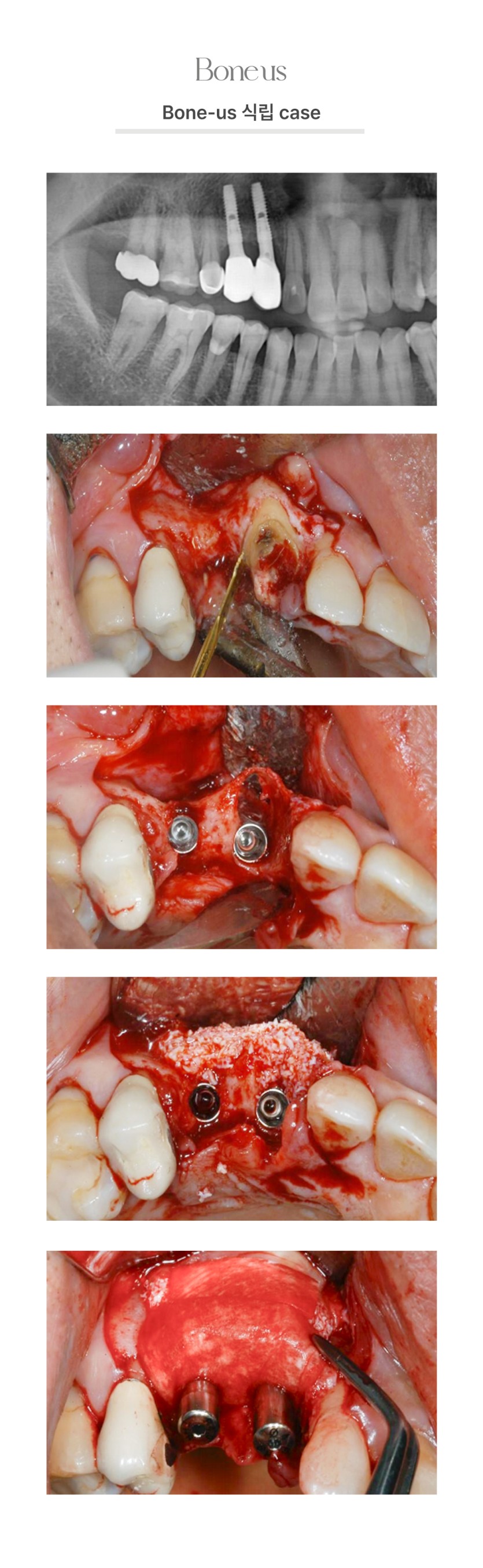 본어스 식립 케이스 7