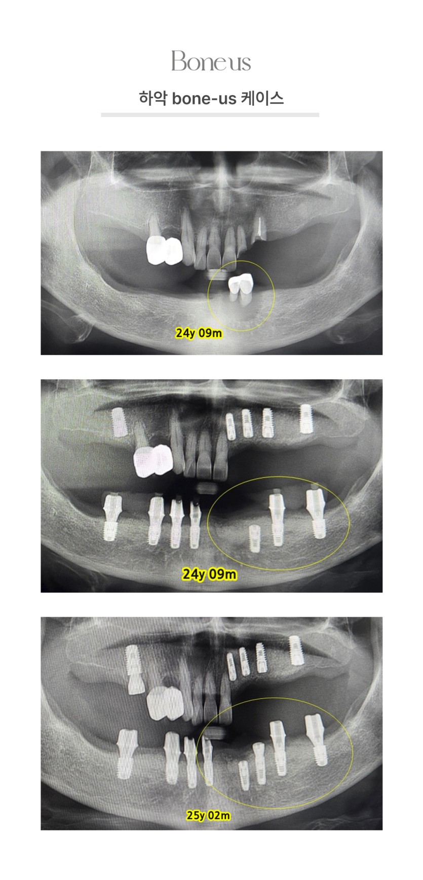 하악 본어스 케이스 2