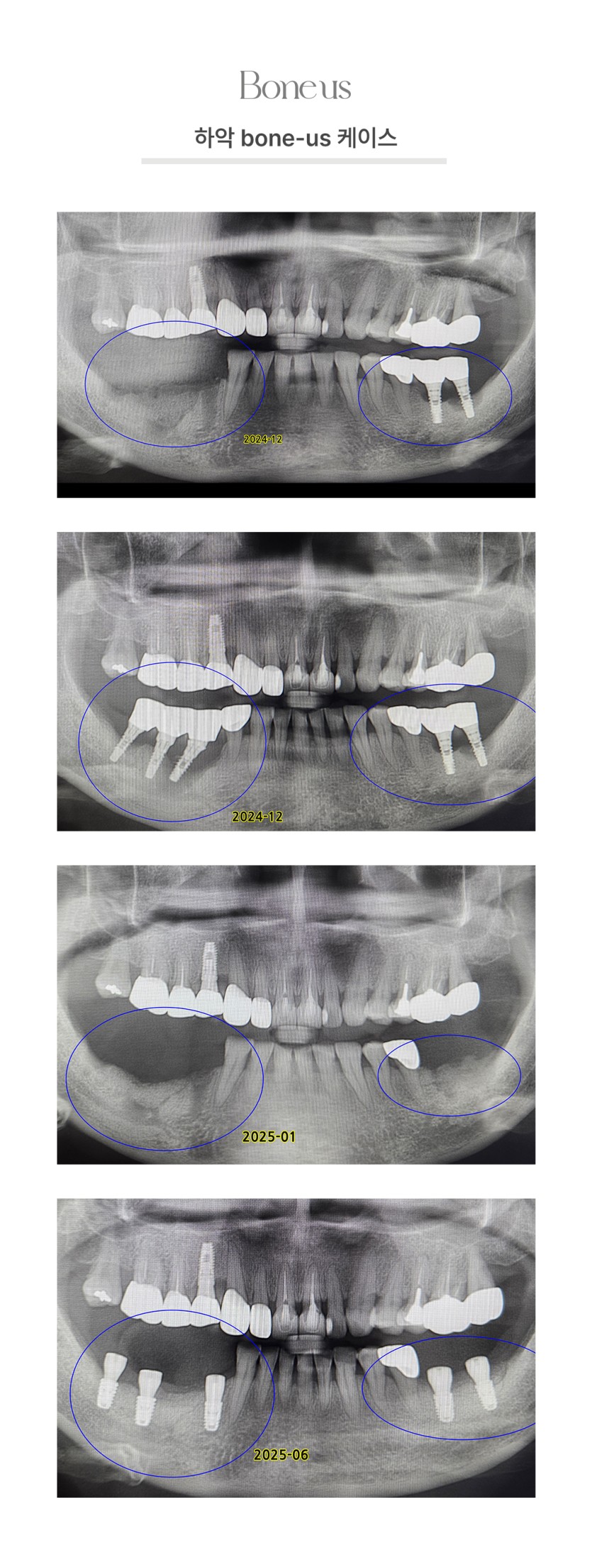 하악 본어스 케이스 4