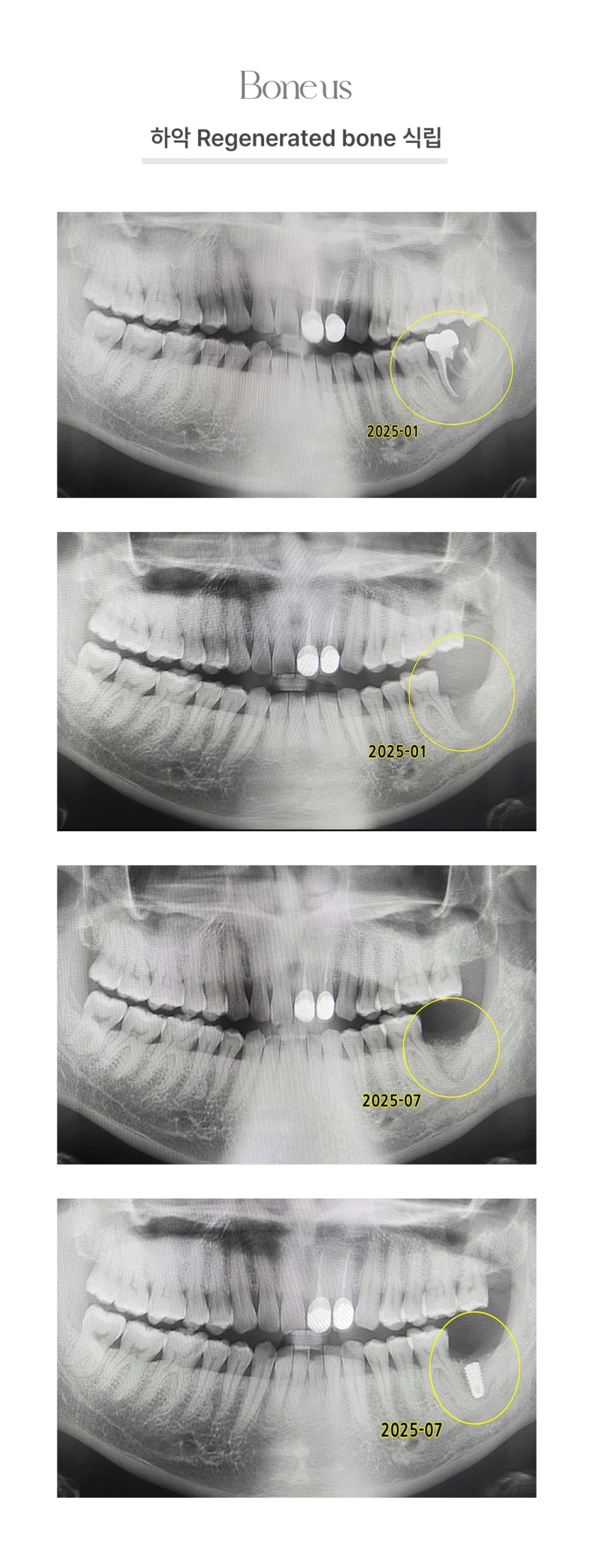 하악 Regenerated bone 식립 2