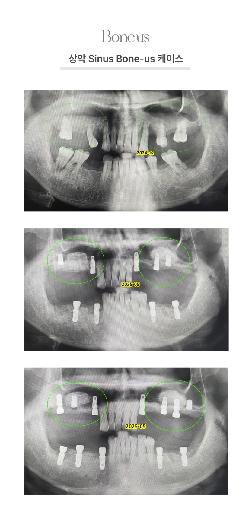 상악 Sinus 본어스 케이스