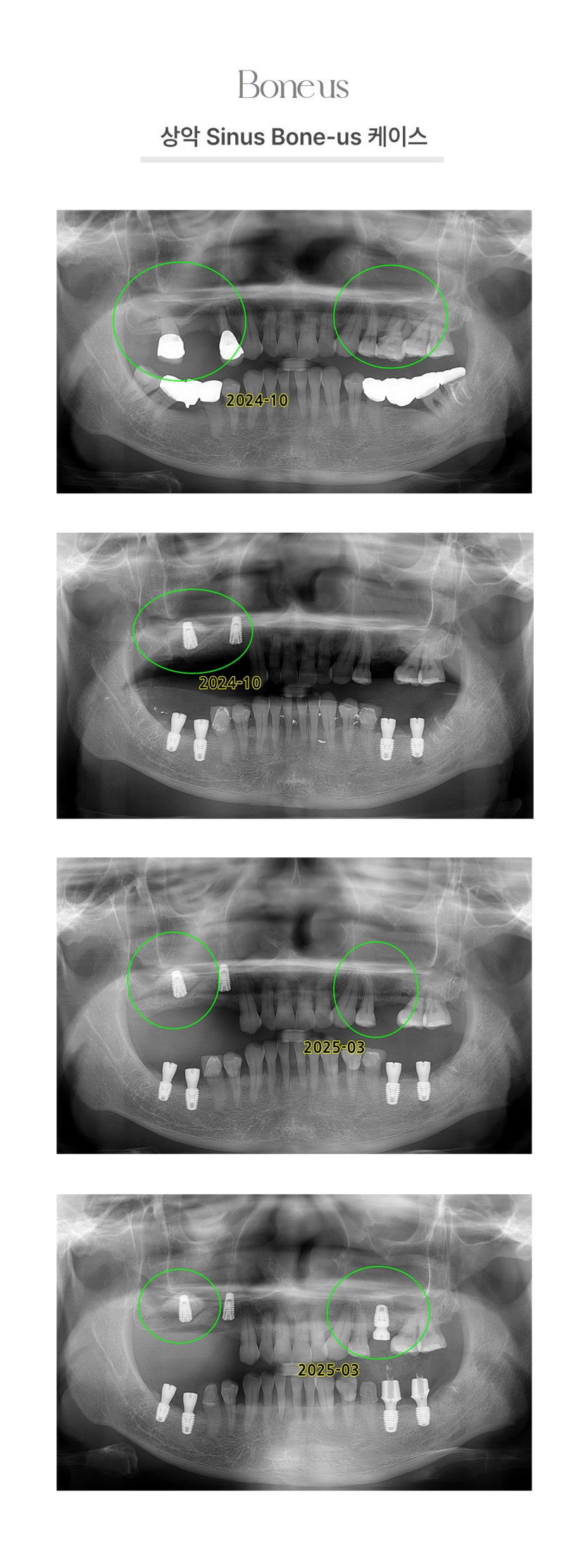 상악 Sinus 본어스 케이스 2